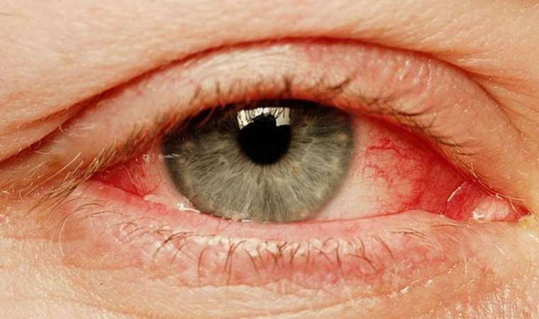 Pakistan’da ‘kırmızı göz’ hastalığı alarmı: Vaka sayısı 86 bini geçti