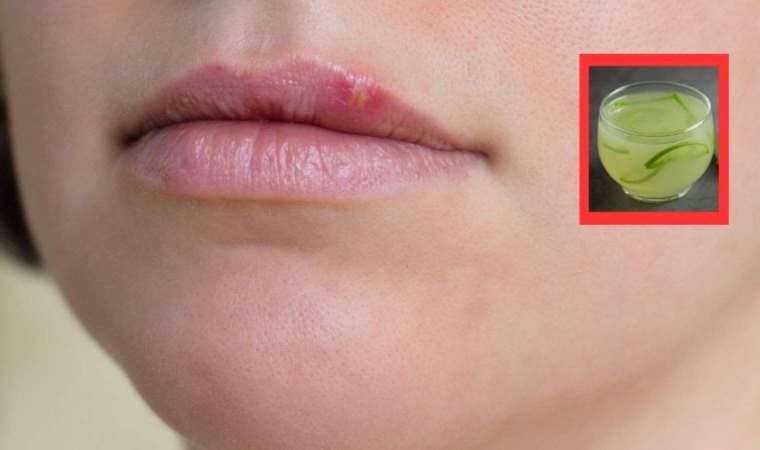 Uçuğu anında geçiren yöntemler neler? Dudak uçuğuna ne iyi gelir?