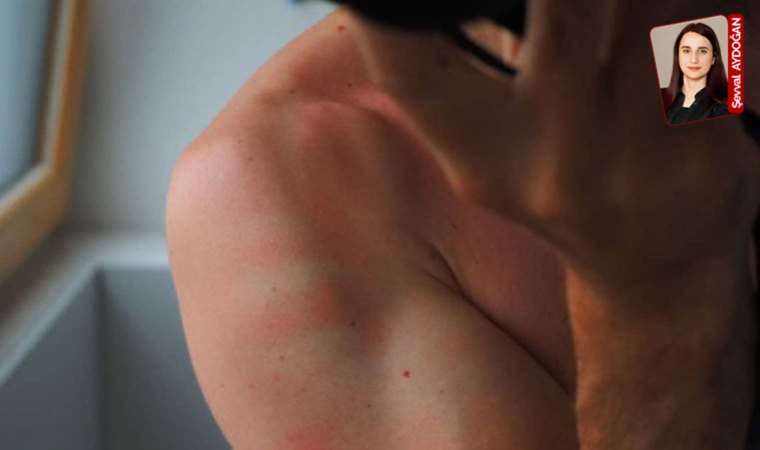 Uyuz vakaları artıyor! Doktorlar uyardı: ‘Yakın temastan kaçınmalı…’