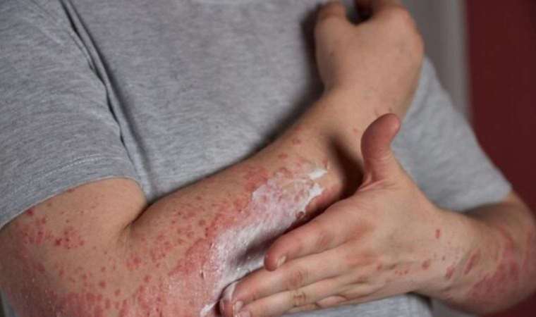 Kelebek hastalığı nedir? Kelebek hastalığı (Lupus) belirtileri nelerdir? Kelebek hastalığının tedavisi var mı? Kelebek hastalığı (Lupus) ölümcül mü?