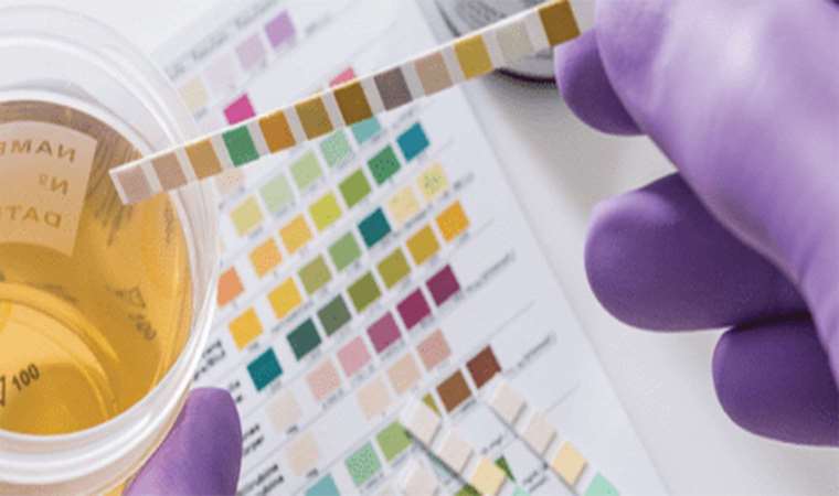 Uzmanı uyardı: İdrarda kan görmeyi hafife almayın