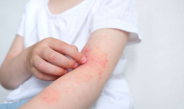 Ece Seçkin’in hastalığı idiyopatik kronik alerji nedir? İdiyopatik kronik alerji neden olur, belirtileri nelerdir?