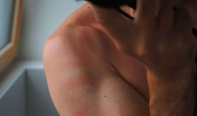 Sağlıkçılardan ‘uyuz’ uyarısı: Vakalar son yıllarda 3-4 kat arttı