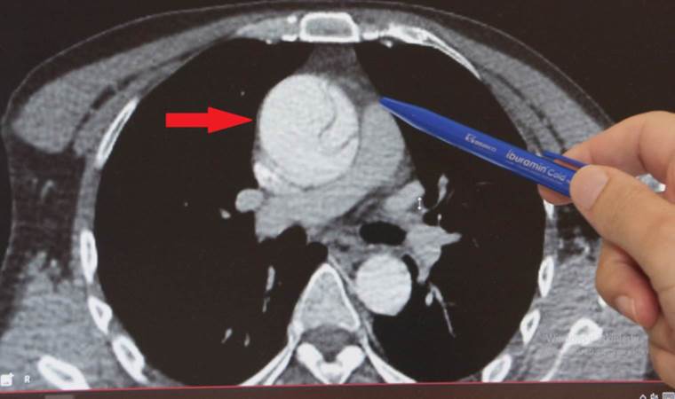 Acildeki doktorun dikkati sayesinde kurtuldu… Mide ağrısı sandı, aort damarında ‘yırtık’ çıktı