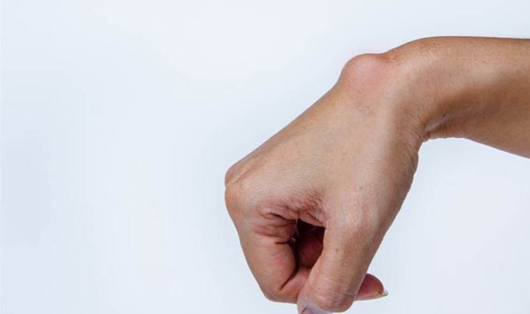 Dermoid kistlerin çok bilinmeyen 3 belirtisi