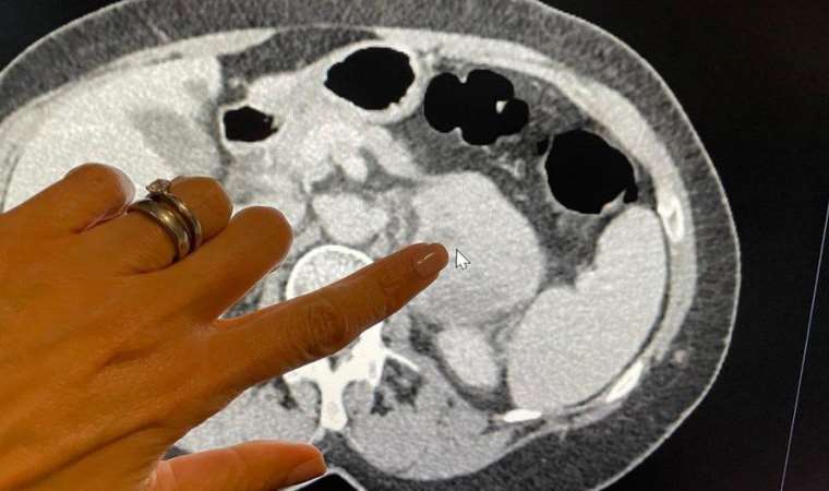 Bilim insanları yapay zekadan umutlu: ‘Kanserin derecesini ve agresifliğini daha isabetli belirleyebilir’