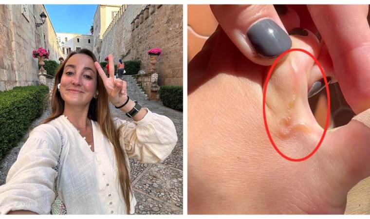 Ünlü Influencer Lucia Pombo, ayaklarındaki parazitleri paylaştı