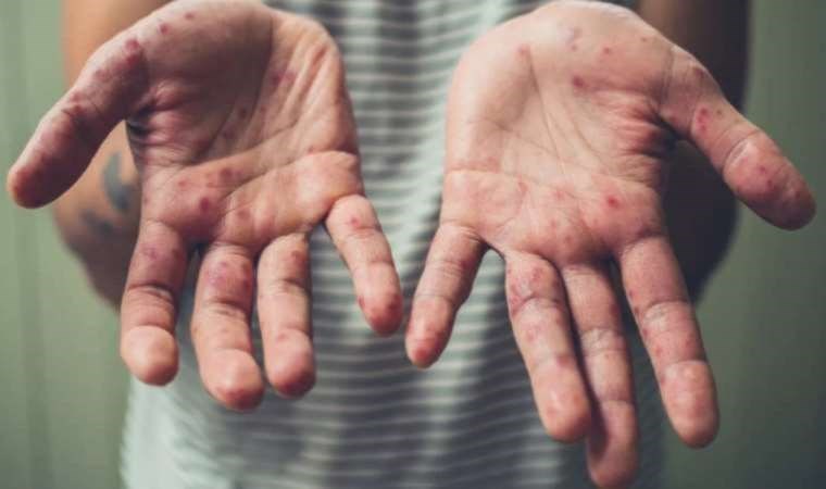 Kızamık vakaları 40 kat arttı! TTB-AHEK Başkanı Kırımlı: Tekrar salgın içerisindeyiz