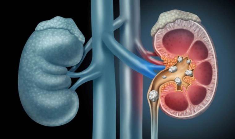 Teknoloji bağılımlarında böbrek taşı riski artıyor