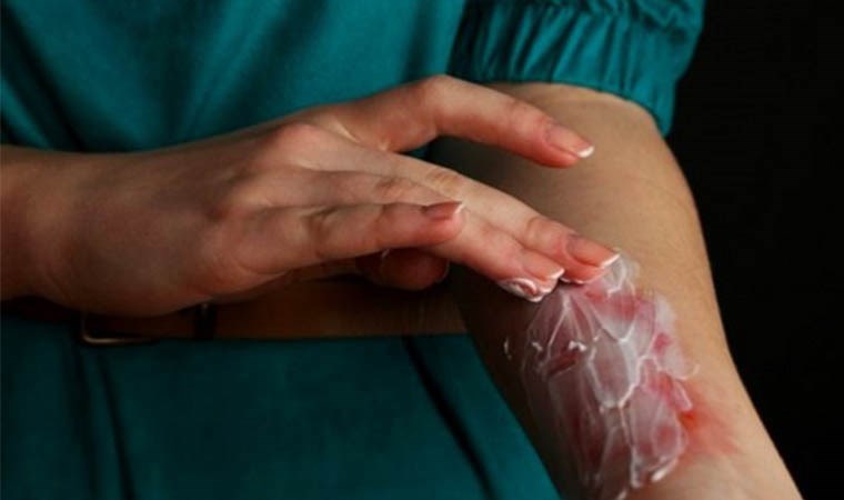 Yanıklara sakın bunları sürmeyin: Diş macunu ve yumurta akı enfeksiyon riskini arttırıyor