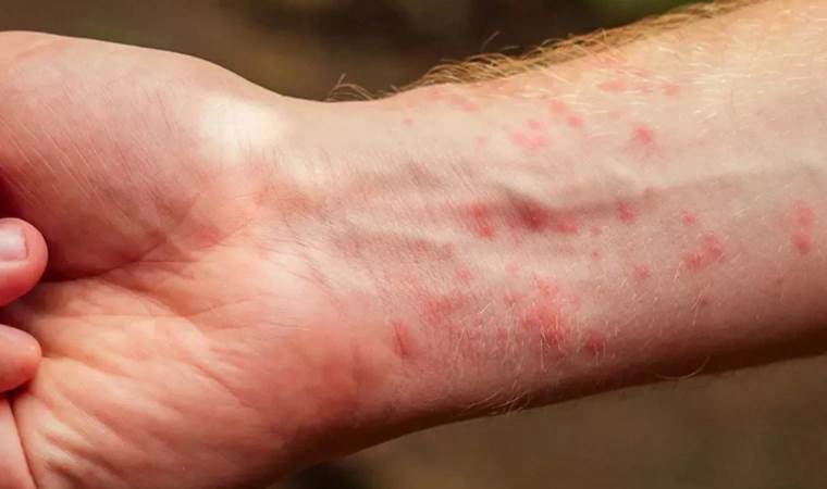 İngiltere’de Viktorya dönemi hastalığı dirildi