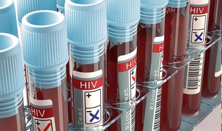 HIV virüsü nedir,  belirtileri nelerdir?  HIV Enfeksiyonu (AIDS) nasıl bulaşır?