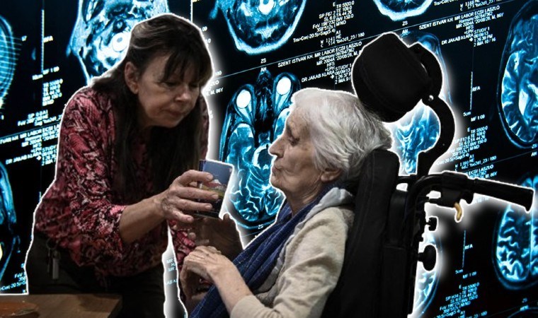 Laboratuvarda üretildi: Alzheimer’a karşı yeni keşif