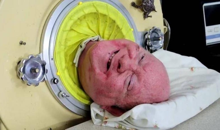 ‘Demir akciğerli adam’ 78 yaşında hayatını kaybetti