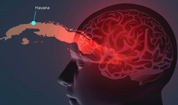 Havana Sendromu hastalarında beyin hasarı olmuyor