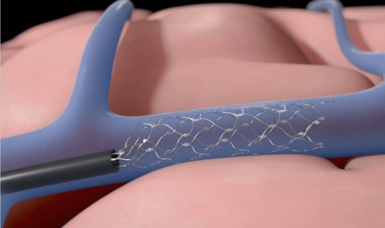 Stentrode, Musk’ın Neuralink’inden çok daha ileride olabilir