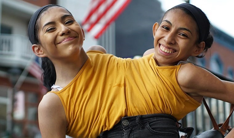 Yapışık ikizlerin yaşamı: Biri ölürse diğerine ne olacak?