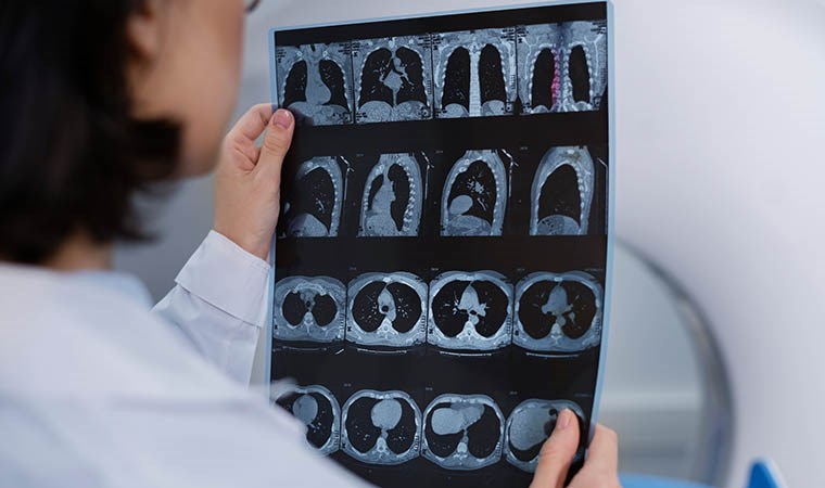 Bilim insanlarından çığır açacak keşif: Alzheimer riskini düşürecek gen bulundu!