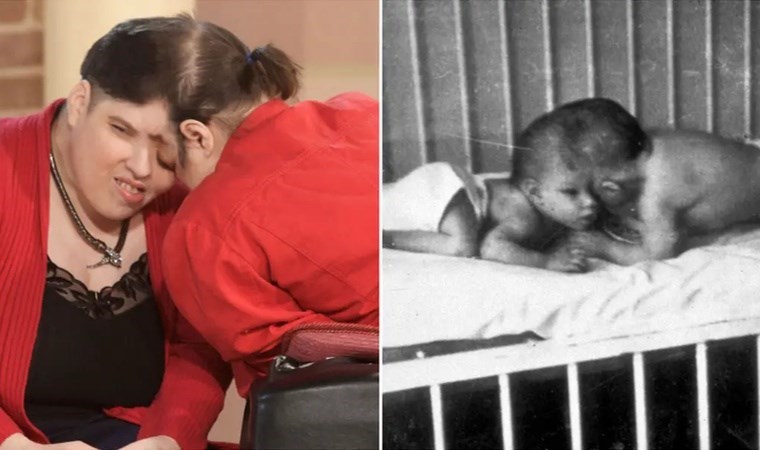 Dünyanın ‘en yaşlı’ yapışık ikizleri hayatını kaybetti