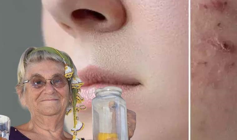 Canan Karatay mucizeyi önerdi! Sivilceli yüzleri tertemiz yapıyor…