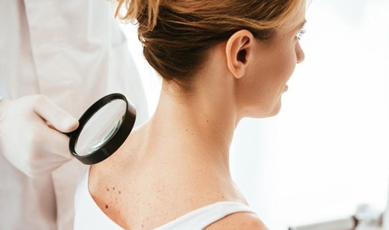 Uzmanından deri kanserleri için ‘güneş’ uyarısı