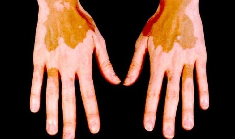 Addison hastalığı nedir? Addison hastalığı belirtileri nelerdir?