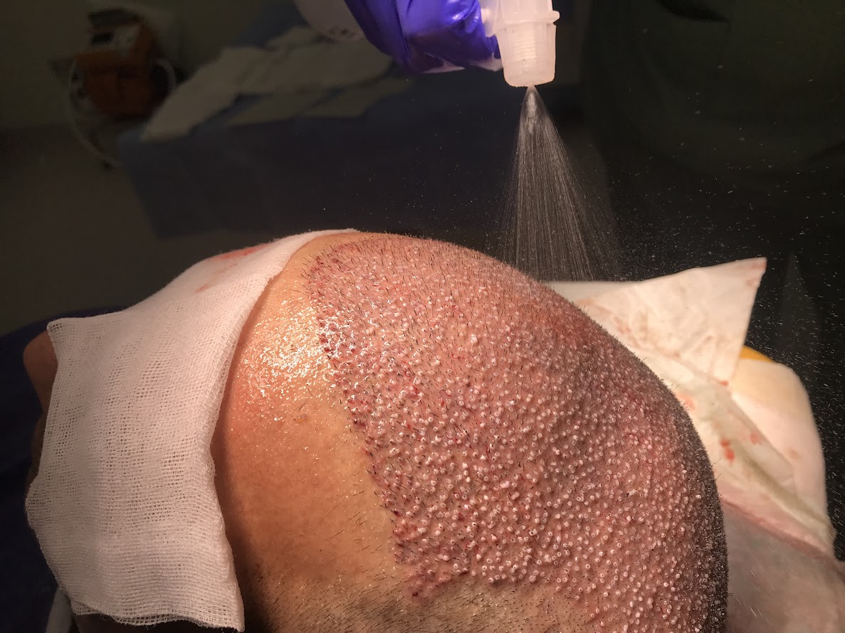 Clinista Saç Ekim Merkezi ile Saç Ekiminde Güvenilir Çözümler