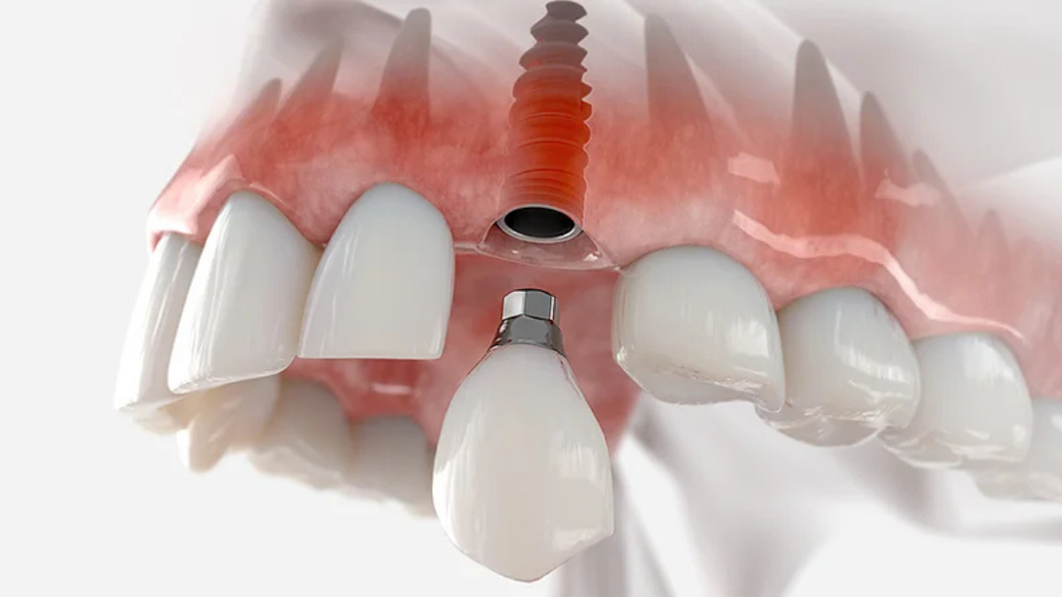 Dental Sektörde Alman Otoritesi: Apexcore İmplant Teknik Analizi