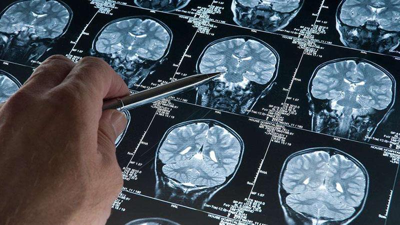 Alzheimer’da Erken Kalkan Yol Alıyor: Kan Testleri ile 50’li Yaşlarda Teşhis Mümkün Mü?